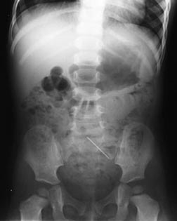 X-ray of one-year old showing a pin.